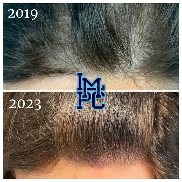 PRP Hair Treatment case 6