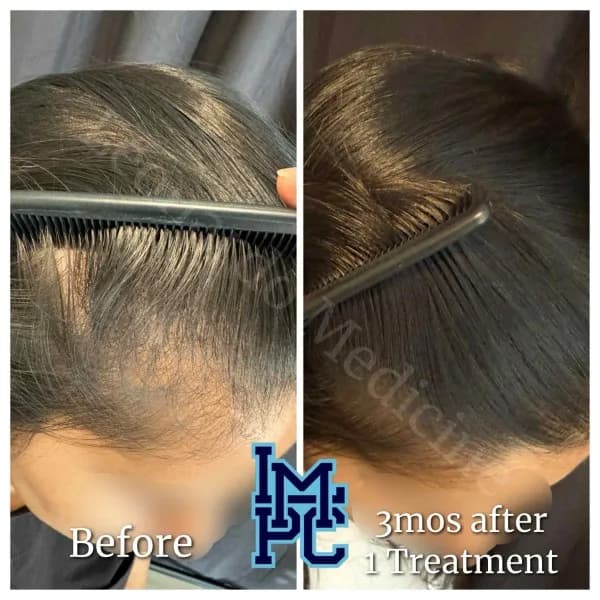 PRP Hair Treatment case 9