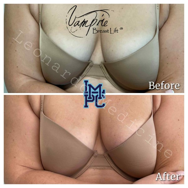 Vampire Breast Lift treatment 4