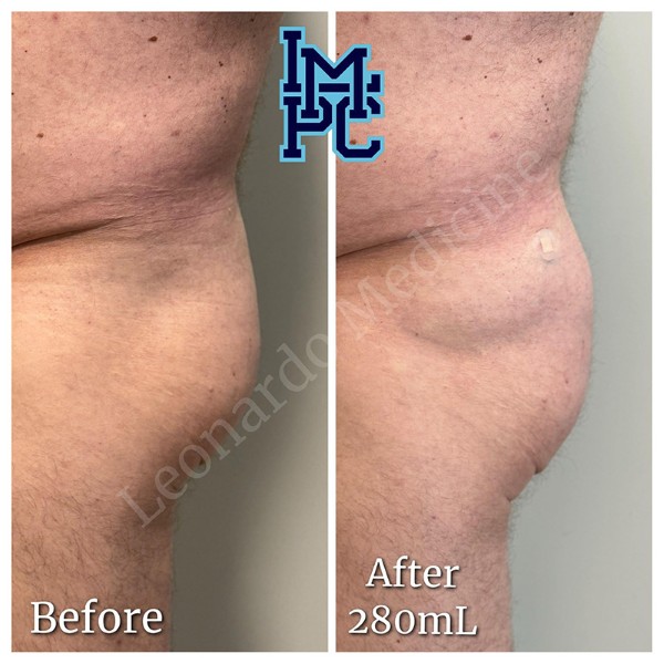Butt Lift treatment 11