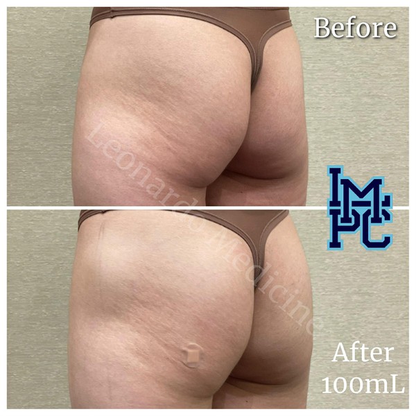 Butt Lift treatment 12