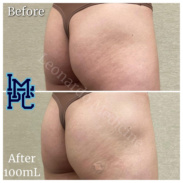 Butt Lift treatment 21