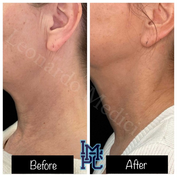 Dilute Radiesse treatment 21