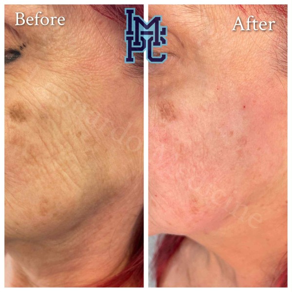 Dilute Radiesse treatment 4