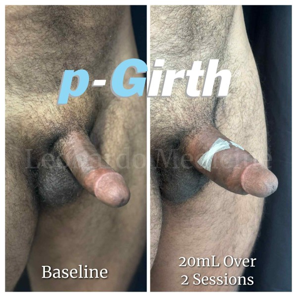 P-Girth® Cut case 40