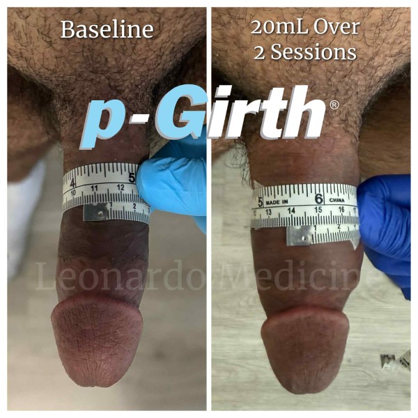 P-Girth® Cut case 41