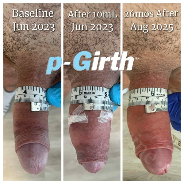 P-Girth Retention case 30