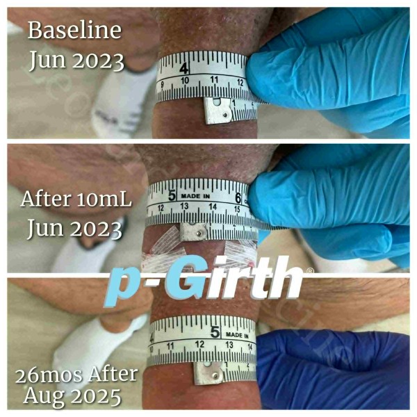 P-Girth Retention case 31