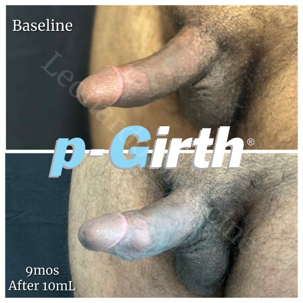 P-Girth Retention case 32