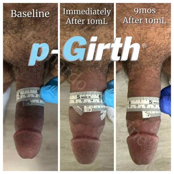 P-Girth Retention case 34