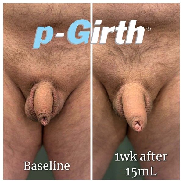 P-Girth Retention case 35