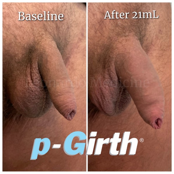 P-Girth® Uncircumcised penis augmentation case 25
