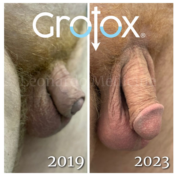 GroTox® treatment 16