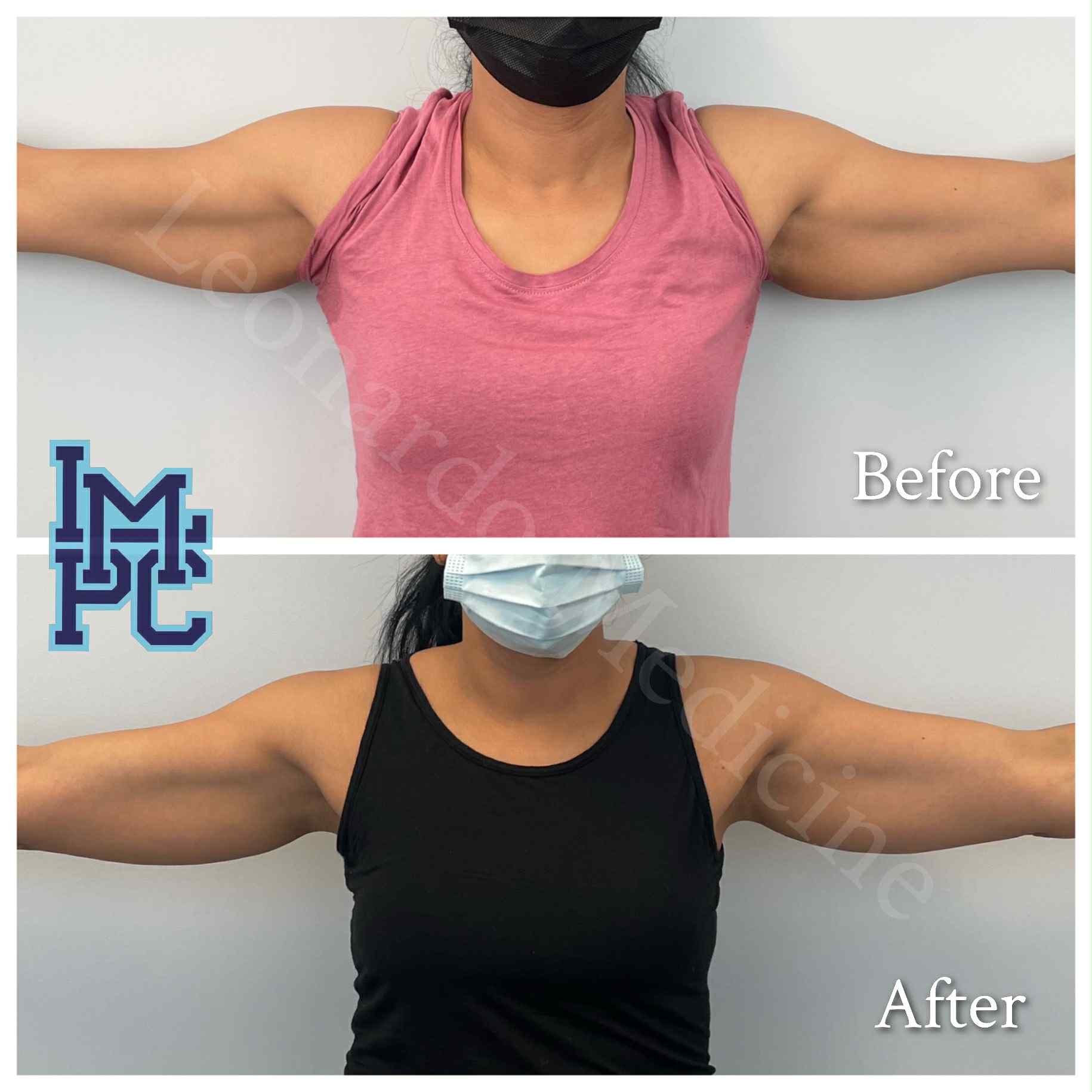 Lipodissolve Treatment 9