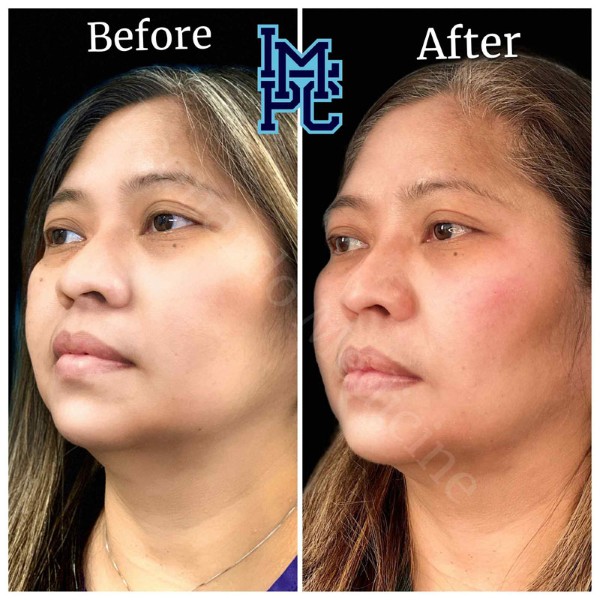 Middle Face Filler treatment 43