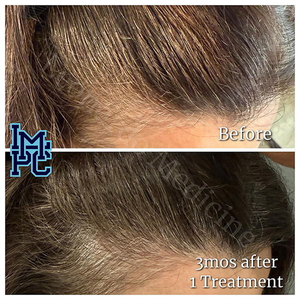 Needleless Hair treatment case 12