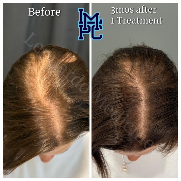 Needleless Hair treatment case 19