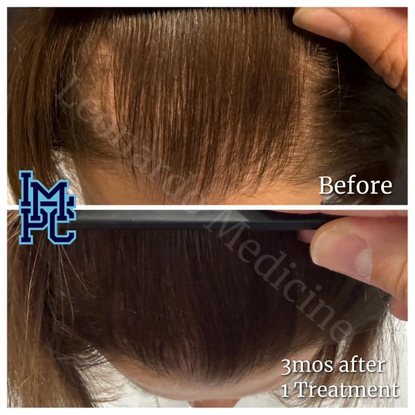 Needleless Hair treatment case 20