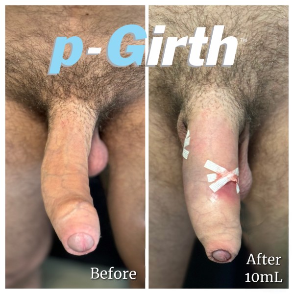 Peyronie's Disease treatment