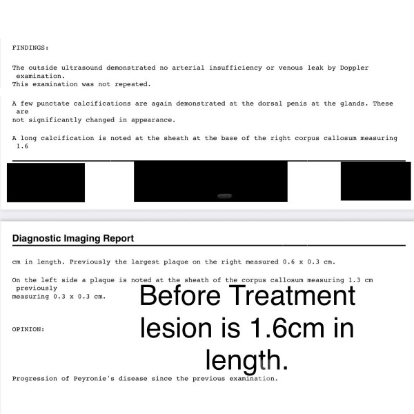 Peyronie's Disease treatment