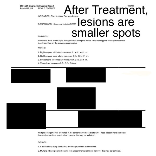 Peyronie's Disease treatment