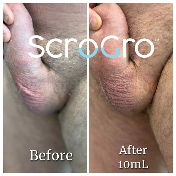 ScroGro™ Filler treatment 11