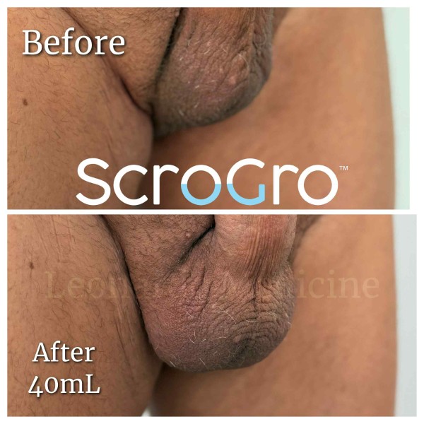 ScroGro™ Filler treatment 6