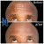 Upper Face Tox treatment 7 thumbnail