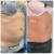 Lipodissolve treatment 12 thumbnail