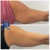 Lipodissolve treatment 17 thumbnail