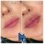 Lower Face Filler treatment 13 thumbnail