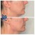 Lower Face Filler treatment 27 thumbnail