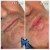 Lower Face Filler treatment 29 thumbnail