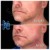 Lower Face Filler treatment 6 thumbnail