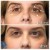 Middle Face Filler treatment 20 thumbnail