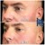 Middle Face Filler treatment 5 thumbnail