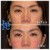 Middle Face Filler treatment 8 thumbnail