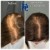 Needleless Hair treatment 19 thumbnail