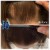 Needleless Hair treatment 20 thumbnail