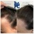 PRP Hair Treatment 8 thumbnail