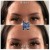 Upper Face Filler treatment 23 thumbnail
